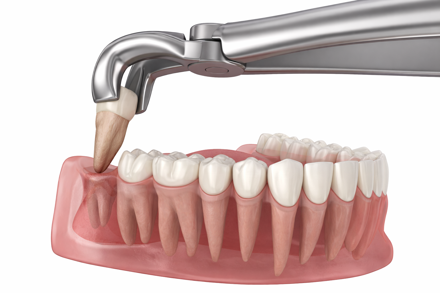 Wisdom Tooth Extraction